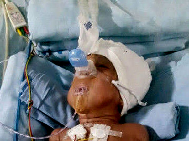 1 year old Diya needs your help for Liver transplant