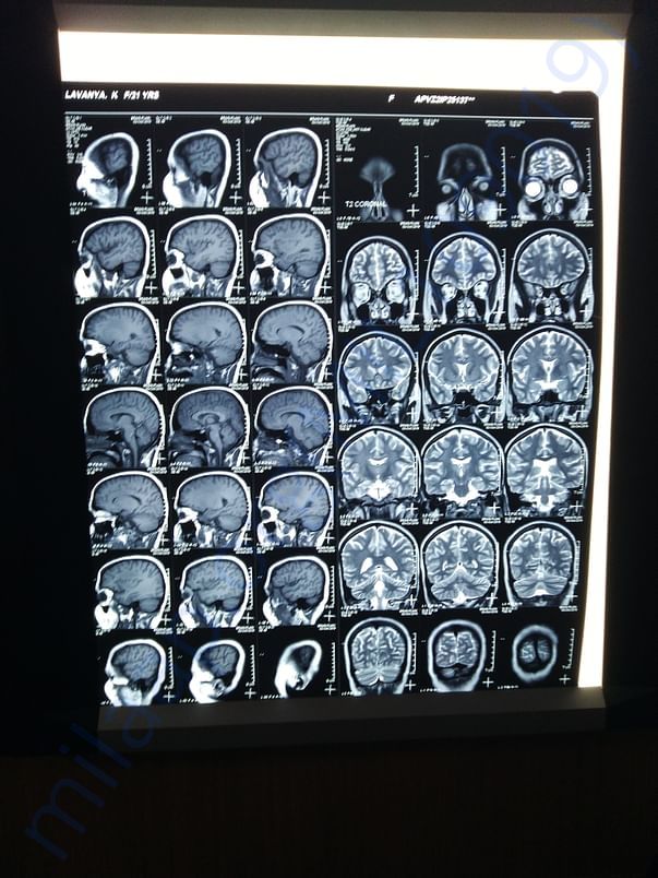 MRI scans of the brain