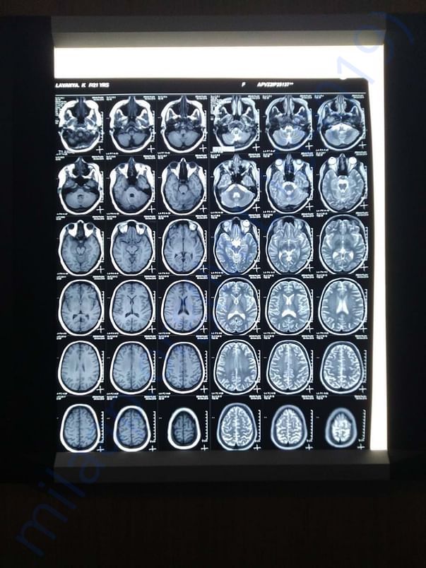 MRI Scan of the brain