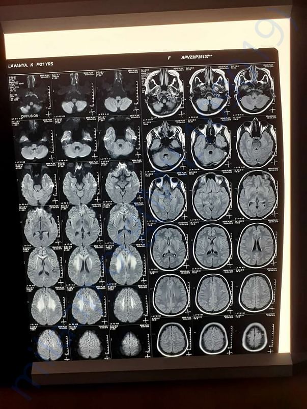 MRI Scan of the brain