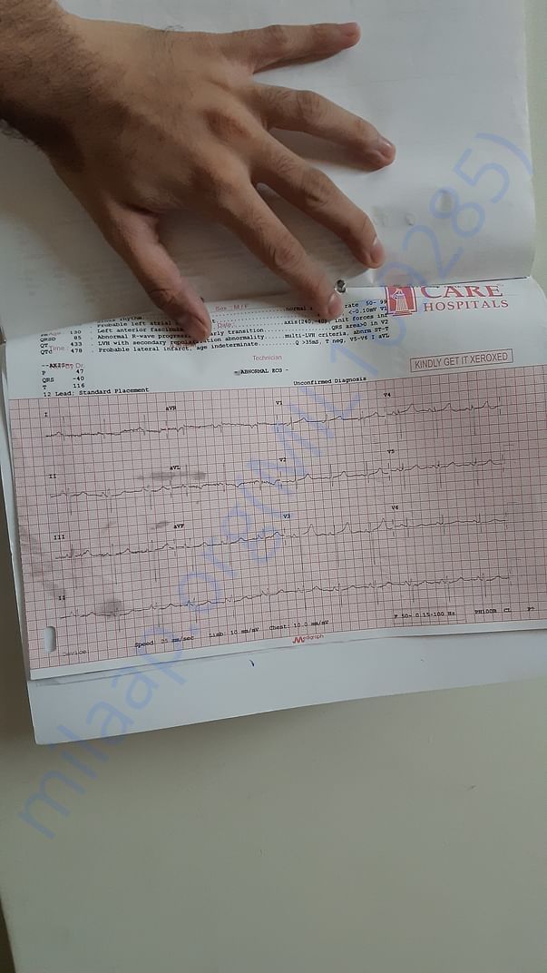 ECG
