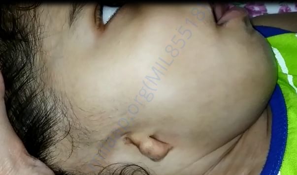 Advait Right Ear