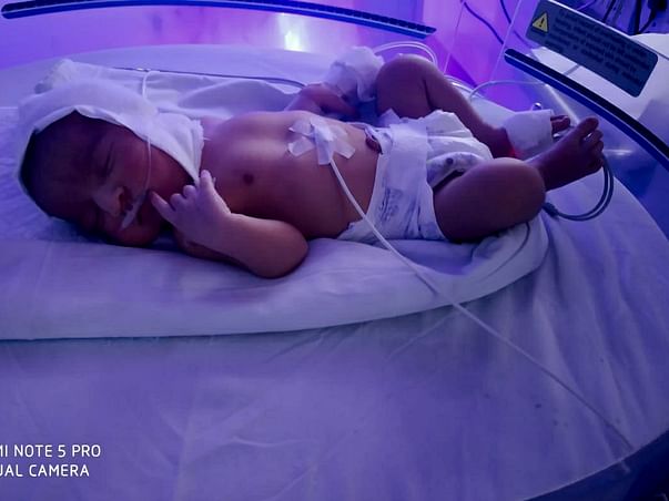 Help me fight Preterm baby/respiratory distress syndrome/hyperbilirubinemia