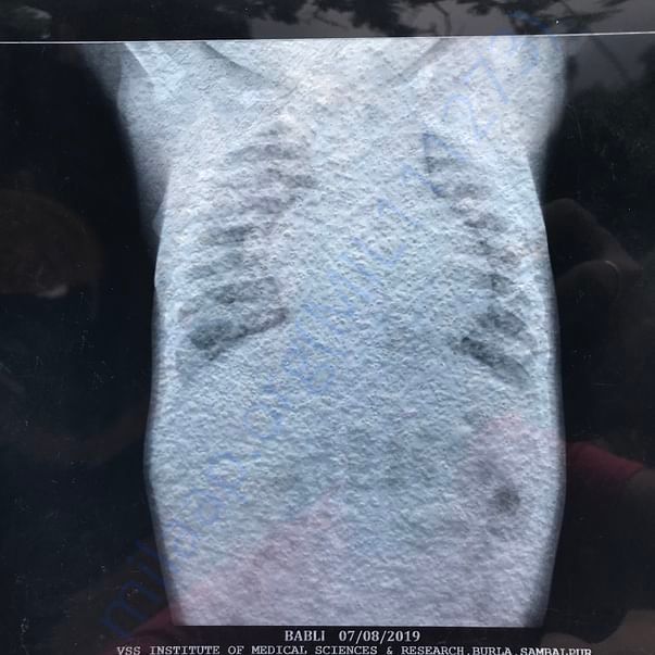 X-Ray
