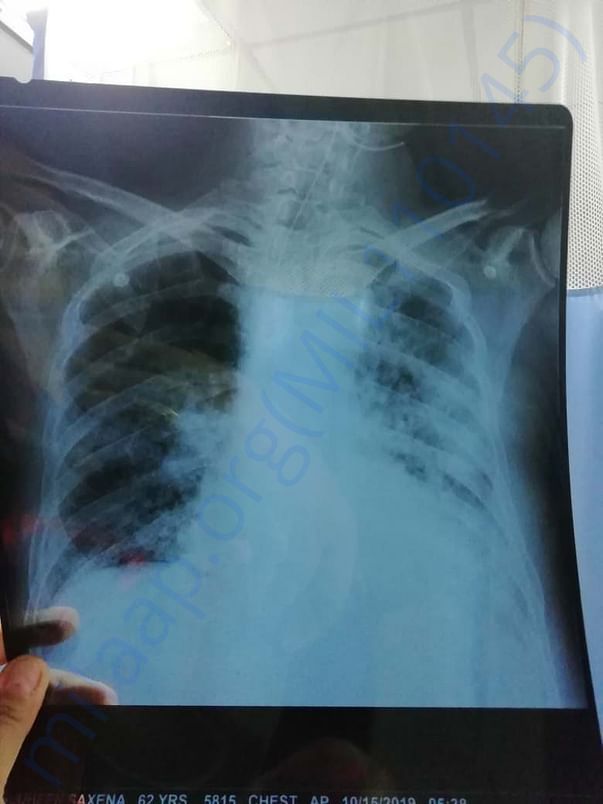 Latest X-ray for chest
