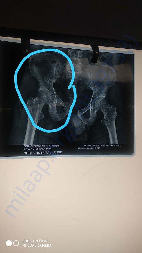 Operation for spine