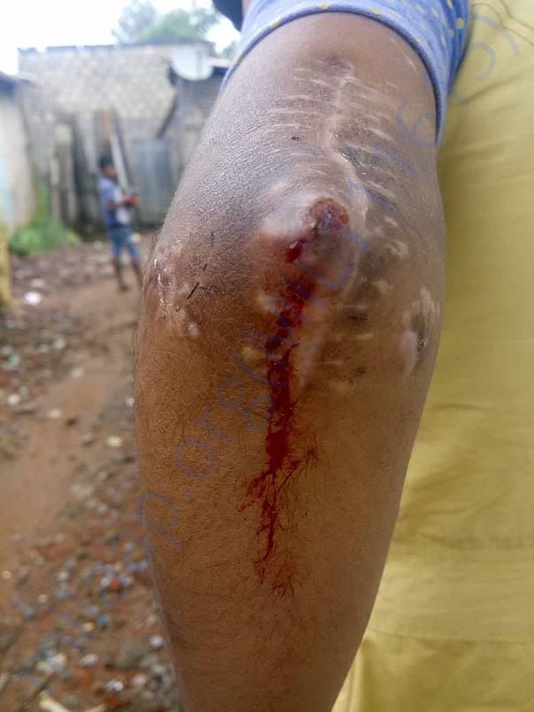 This is the condition of her hand