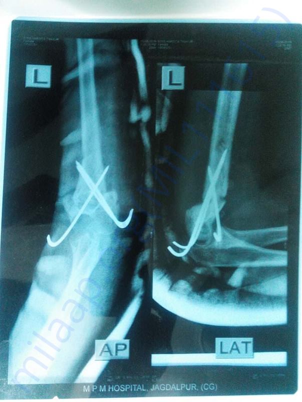 X-ray of her hand