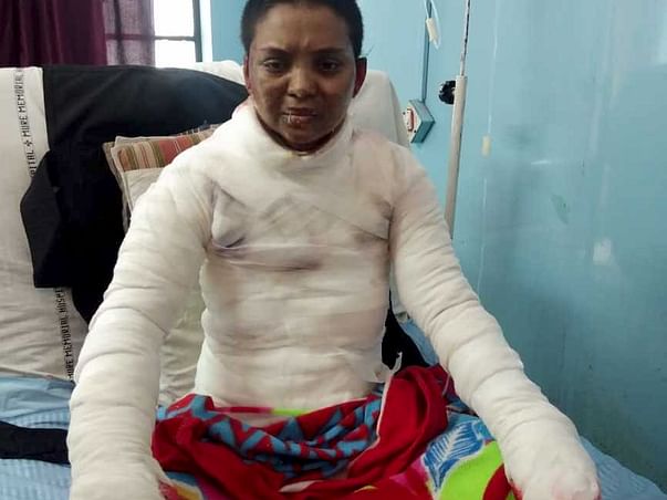 Please Help Shital Recover From Severe Body Burns
