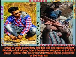 I’m Struggling With Ankylosing Spondylitis, 2 years bedridden Help Me