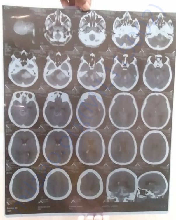 X ray pic of brain