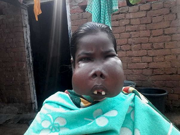 Help Shanti Tirkey Fight Oral Cancer