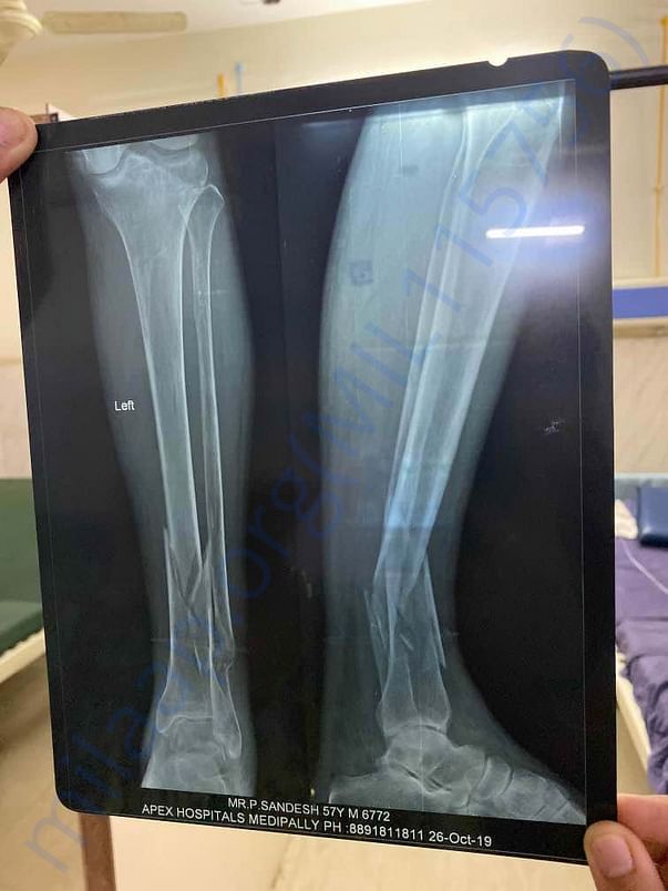 X-RAY