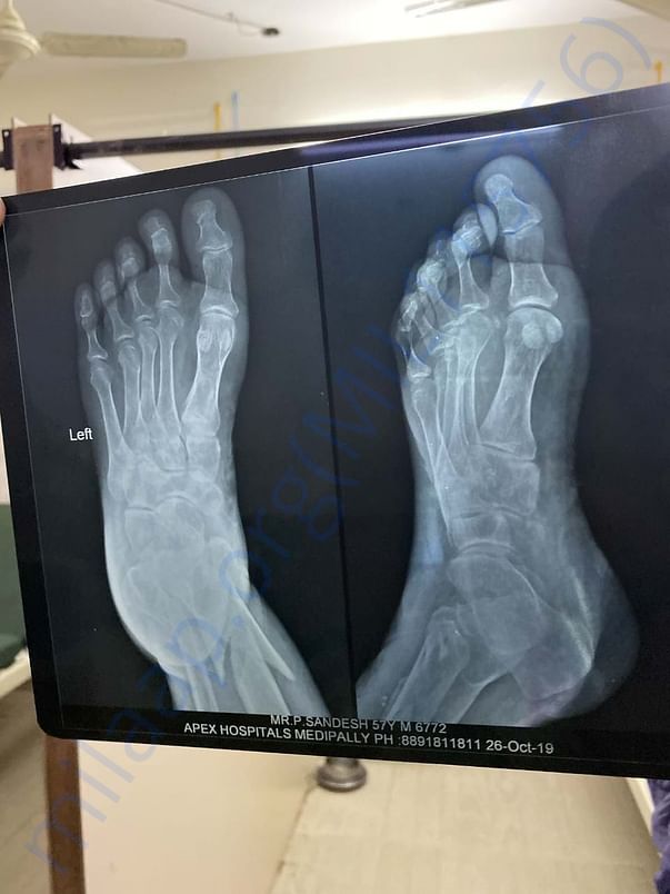 X-RAY