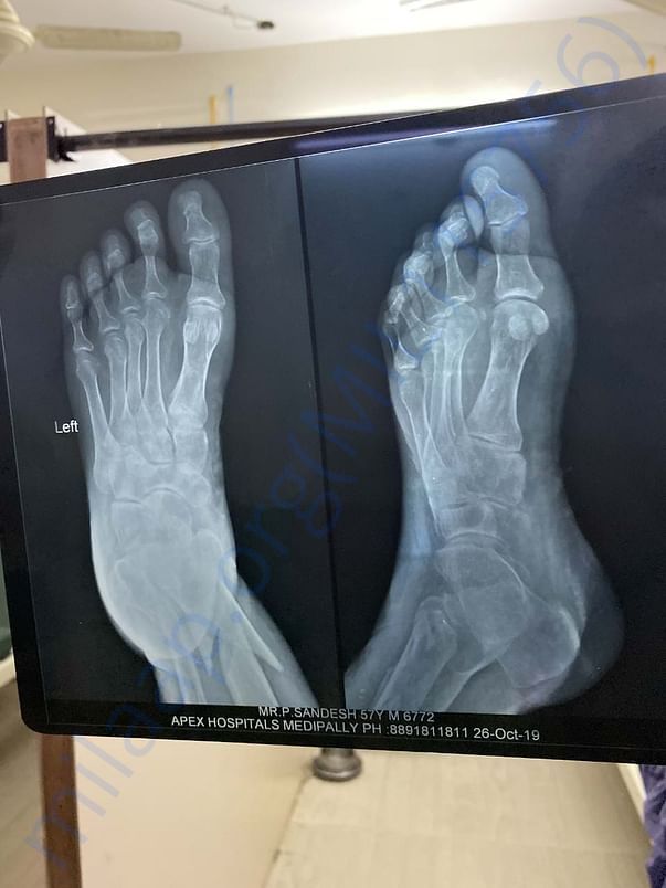 X-RAY