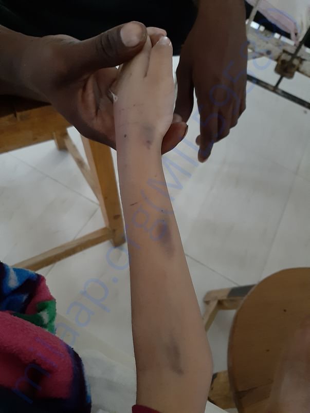 SAMARTH hand damaged due to inserting syringes in hand.