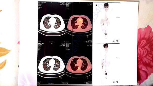 X-RAY