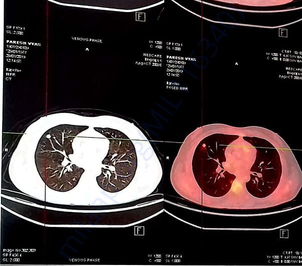 X-RAY