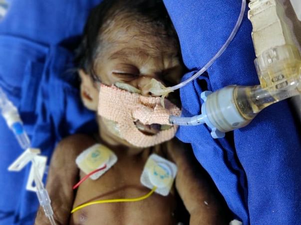 My Son Is Struggling With Preterm Baby Extremely Low Birth Weight, Help Him