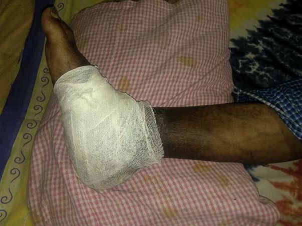 Help Me Fight Chronic Osteomyelitis
