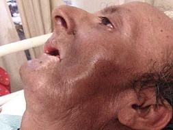 Support Nirmal Jha Recover From Throat Cancer