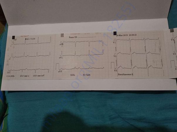 ecg