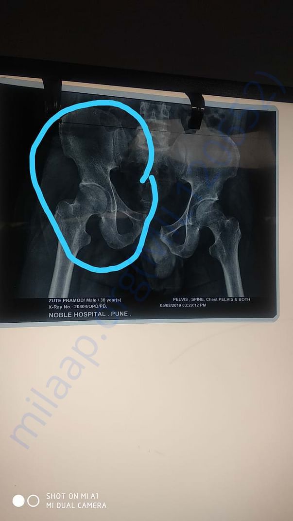 X-RAY
