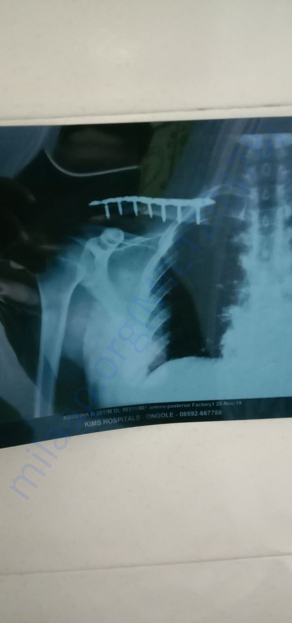 x ray after surgery