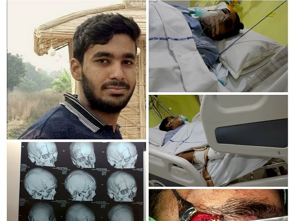 My Brother Is Struggling With Multiple Skulls, Facial Bones Fracture And Brain Injury, Help Him