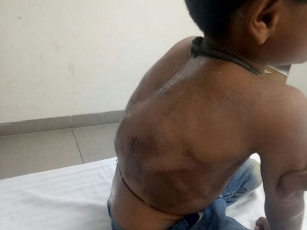 My Son Is Struggling With Birth Defect(Spine Defect), Help Him.