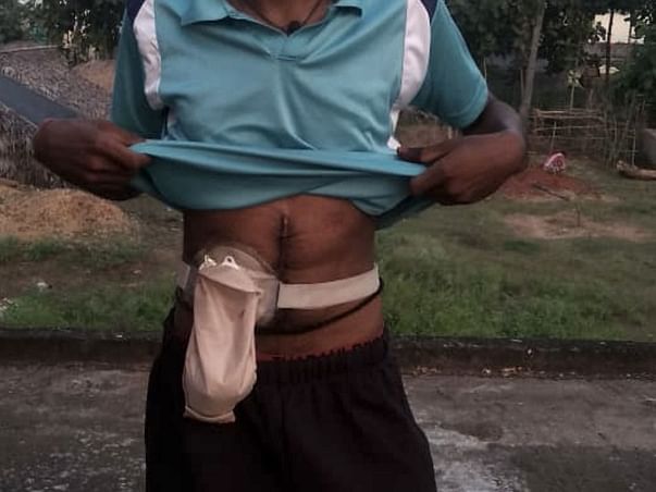 Help Pathivada Adinarayana undergo laparotomy reversal of ileostomy