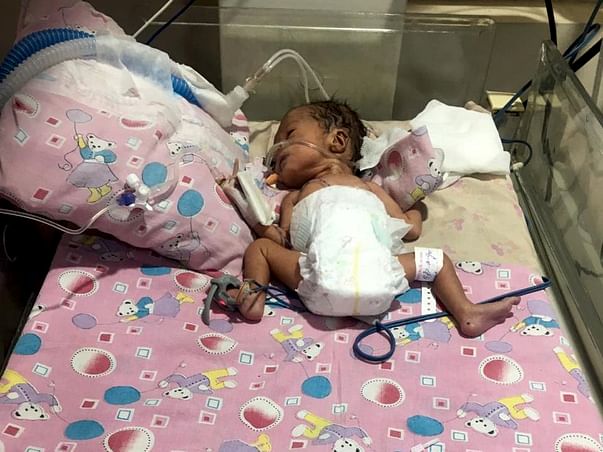 1-month-old Babyanshika Dubey Needs Your Help Fight Ventilator-associated Pneumonia