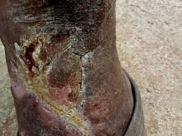 Support Satyanarayana Recover From Ulcer Wound In Left Leg