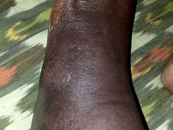 Support N.Srinivas Recover From Cellulitis