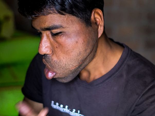 Rare Disease Has Caused His Face To Swell Like Abnormally