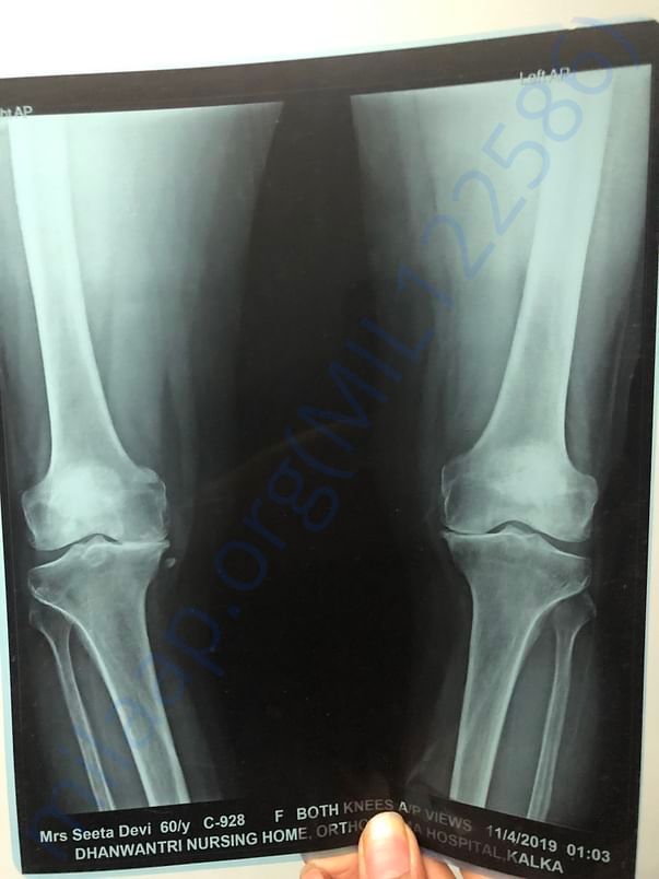 Knee xray( she can’t walk bcoz her joints are fully damaged)