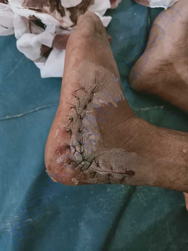 Stitches
