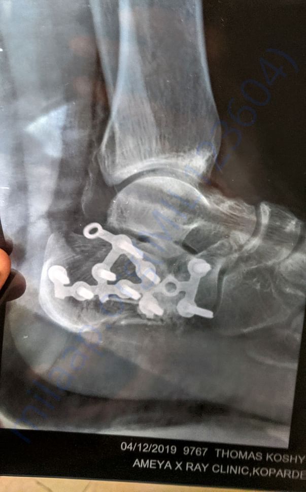 X Ray result after operation