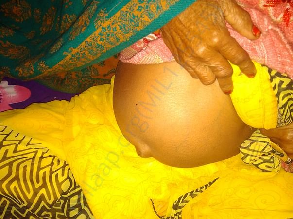Shanti Devi stomach condition