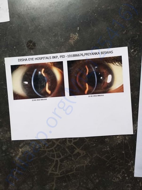 Eyes cornea condition very bad
