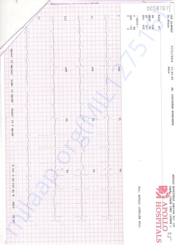 Ecg