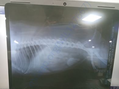 XRay representing bladder stone