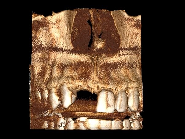 Help me for Teeth Implant - Immediate Help needed