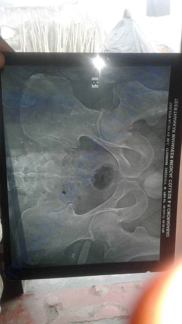 Xray