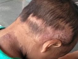 4 Years Old Daivik Needs Your Help Fight Incontinentia Pigmenti