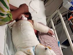 Help Pihu Need Your Help Recover From Water Burn