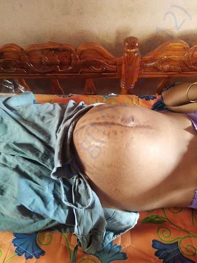 Swelling stomach