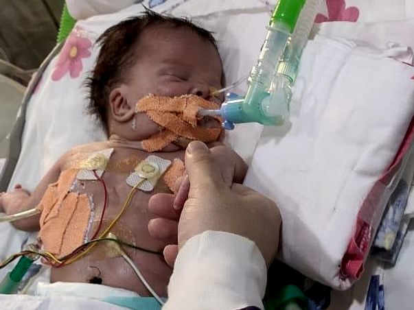 26 Days Old Baby Needs Your Help Fight Hydrops with chylothorax