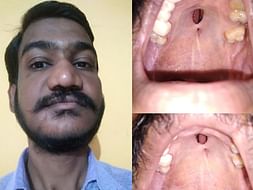 Help Me To Cure From Hole in Palate