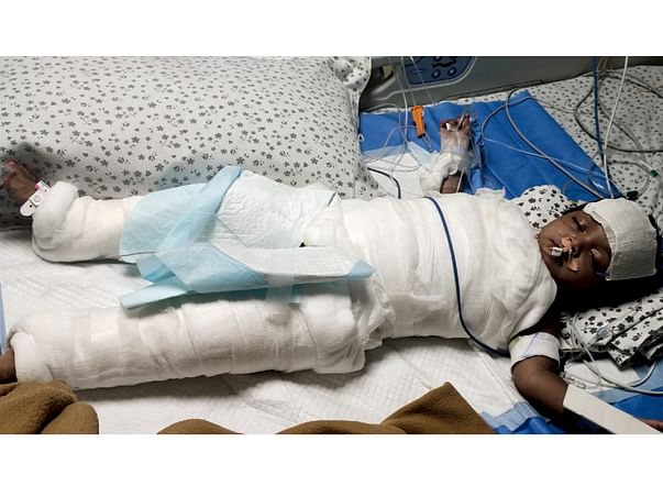 She Suffered For 12 Hours Before Getting Her Burns Treated